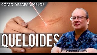 Cómo DESAPARECER las DESAGRADABLES CICATRICES QUELOIDES 🙂 Dr ALBERTO CALVO QUIROZ [upl. by Persian860]