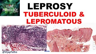 LEPROSY etiopathogenesis classification Tuberculoid amp lepromatous leprosy [upl. by Loggia287]