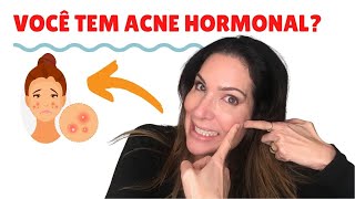 Como saber se você tem ACNE HORMONAL e oque fazer para melhorar [upl. by Shute]