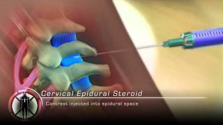 WATCH an Epidural Steroid Injection Demonstration  LIVE [upl. by Charmion]