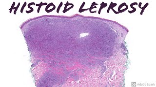 quotHistoidquot Lepromatous Leprosy Hansen disease [upl. by Llednor]