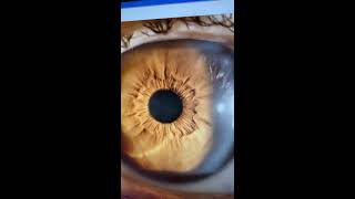 Successful PTK for advanced EKCrelated cornea blindness Kanellopoulos MD [upl. by Jary792]