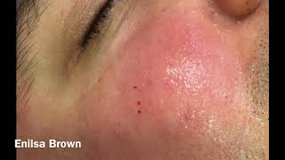 Christians Acne Treatment  Blackheads Extractions [upl. by Enimzzaj806]