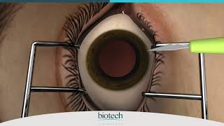 Eyecryl PHAKIC IOL Range Loading amp Implantation [upl. by Nic]