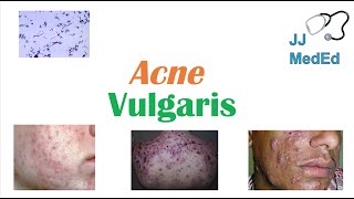 Acne Vulgaris  Causes Pathogenesis Influencing Factors Diagnosis Treatment and Complications [upl. by Emiolhs]