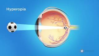 What is Hyperopia Farsightedness [upl. by Moulton]