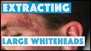 Acne Vulgaris and Extracting large Whiteheads  Part 1 [upl. by Diet]