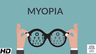 Myopia Signs and Symptoms Causes Diagnosis and Treatment [upl. by Adalia]