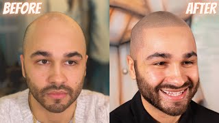 VERY IMPRESSIVE Scalp Micropigmentation Result with Matt Iulo [upl. by Siward]