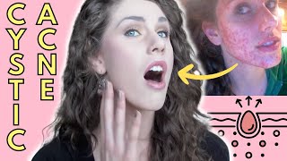 What Is Cystic Acne Causes Treatment  Cassandra Bankson [upl. by Nailimixam]