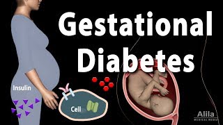 Gestational Diabetes Animation [upl. by Archibold]