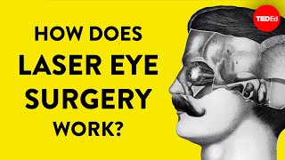 How does laser eye surgery work  Dan Reinstein [upl. by Radborne]