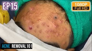 Cystic Acne Extraction 20mn  Acne treatment by ACNEREMOVAL101 [upl. by Pell]