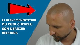 La Dermopigmentation du cuir chevelu son dernier recours [upl. by Nywg]