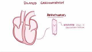 Dilated cardiomyopathy DCM causes symptoms diagnosis treatment amp pathology [upl. by Celina]