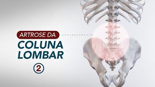 Artrose da coluna lombar tratamento [upl. by Cl]