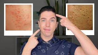 How to Get Rid of Acne Scars [upl. by Su]