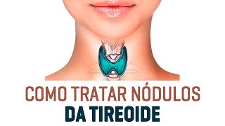 Como Tratar Nódulos Da Tireoide Dr Rogério Leite [upl. by Trevlac]