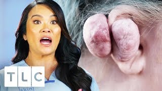 Dr Lee Removes 14 Oz Keloid From Womans Ear  Dr Pimple Popper [upl. by Naej739]