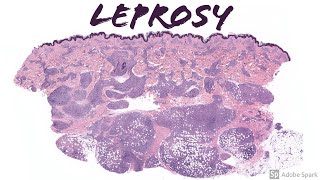 Lepromatous Leprosy Hansen Disease 5Minute Pathology Pearls [upl. by Janaye]