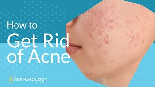 Acne Treatment  Explained by Dermatologist [upl. by Holofernes768]