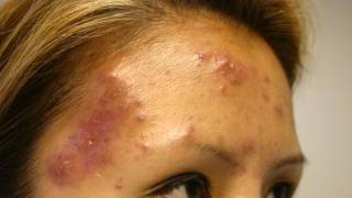 The Acne Practice severe case 5 [upl. by Chevy]